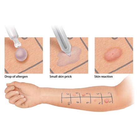 nose allergy testing