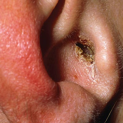 Ear infection specialist in Kukatpally