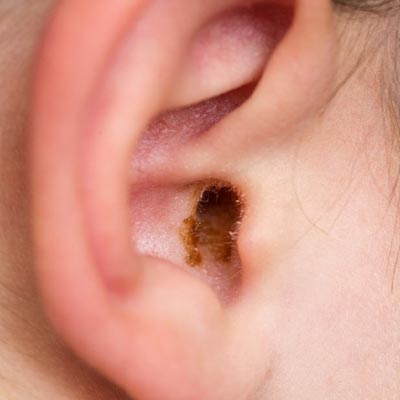 Ear wax hospital in Miyapur