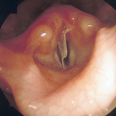 Laryngeal foreign body treatment