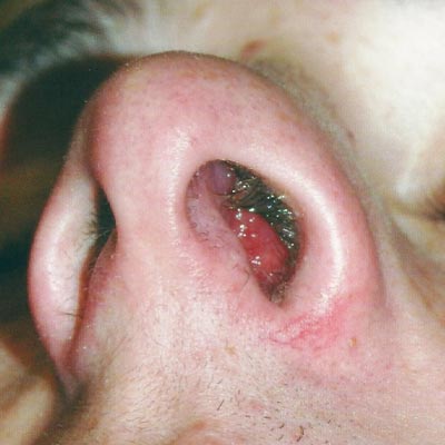 best Nasal trauma clinics in Hyderabad
