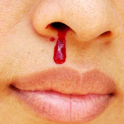 Nose bleeds treatment in Hyderabad