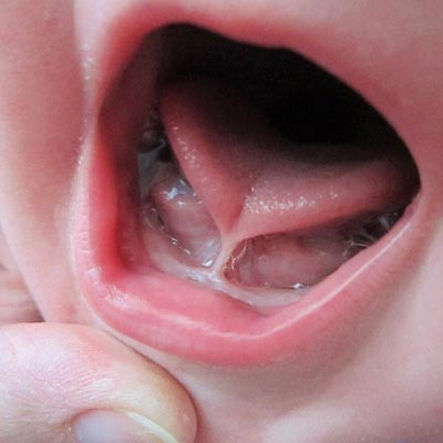 Tongue tie specialist in Hyderabad